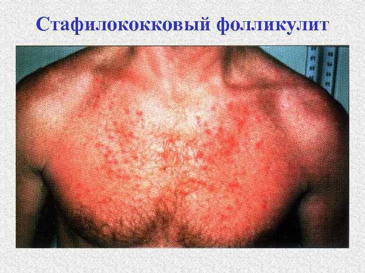 Стафилококковый фолликулит 