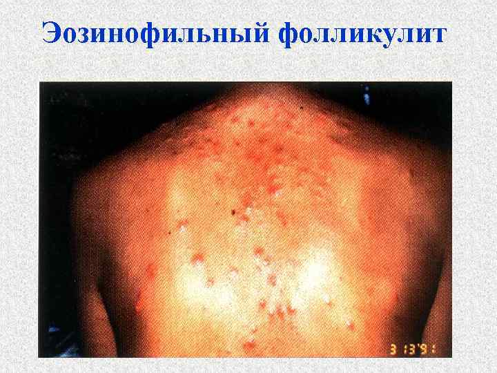Эозинофильный фолликулит 
