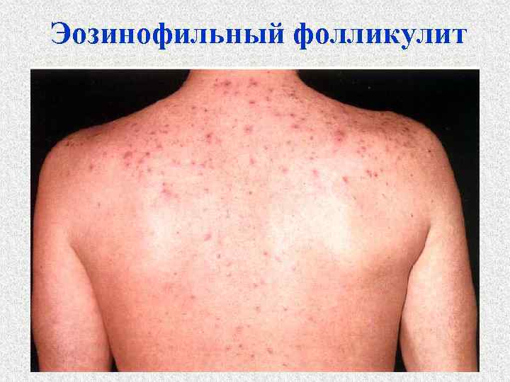 Эозинофильный фолликулит 