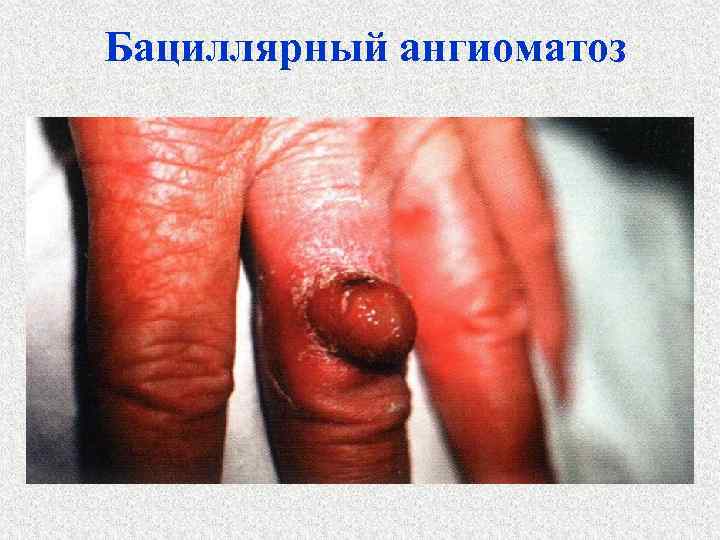 Бациллярный ангиоматоз 