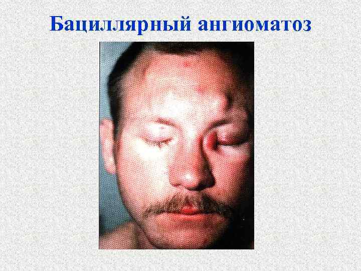 Бациллярный ангиоматоз 