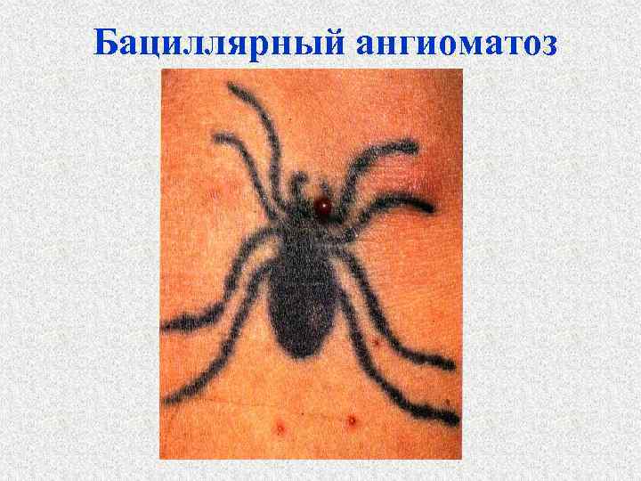 Бациллярный ангиоматоз 