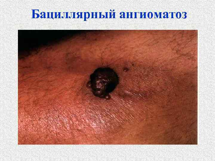 Бациллярный ангиоматоз 