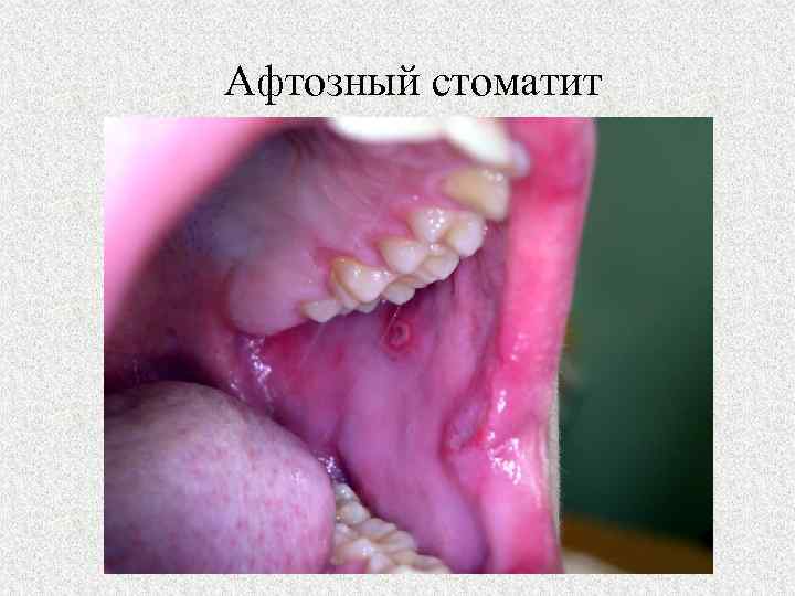 Афтозный стоматит 