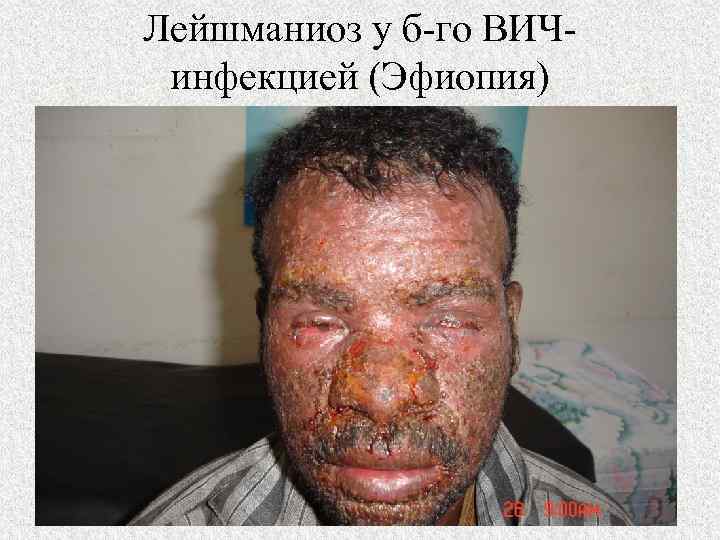 Лейшманиоз у б-го ВИЧинфекцией (Эфиопия) 