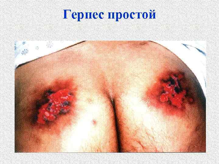 Герпес простой 