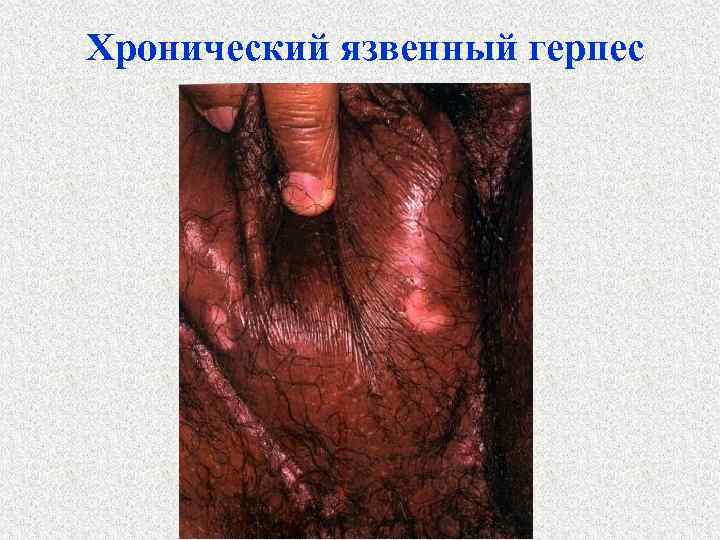 Хронический язвенный герпес 