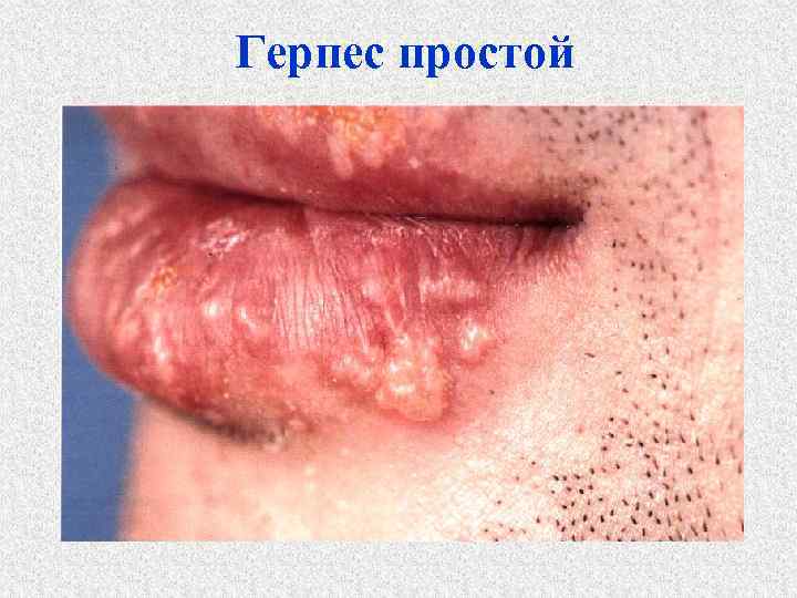 Герпес простой 