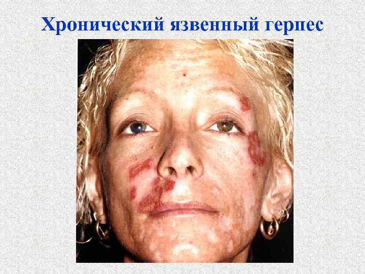 Хронический язвенный герпес 