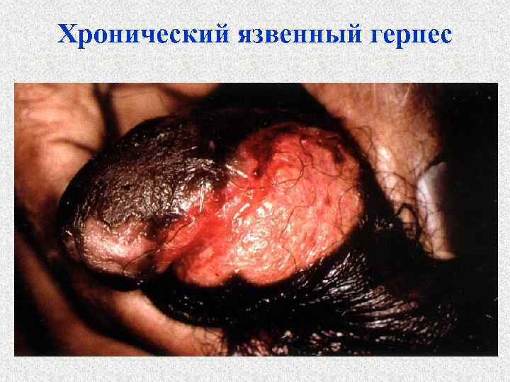 Хронический язвенный герпес 