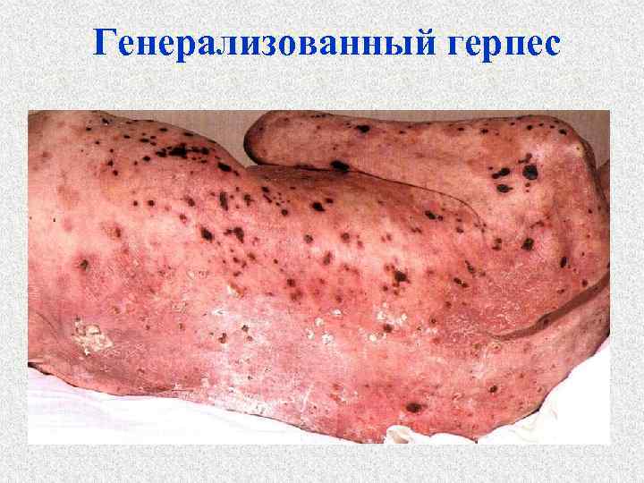 Генерализованный герпес 