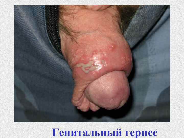 Генитальный герпес 