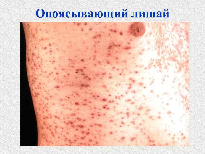 Опоясывающий лишай 