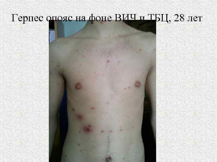 Герпес опояс на фоне ВИЧ и ТБЦ, 28 лет 