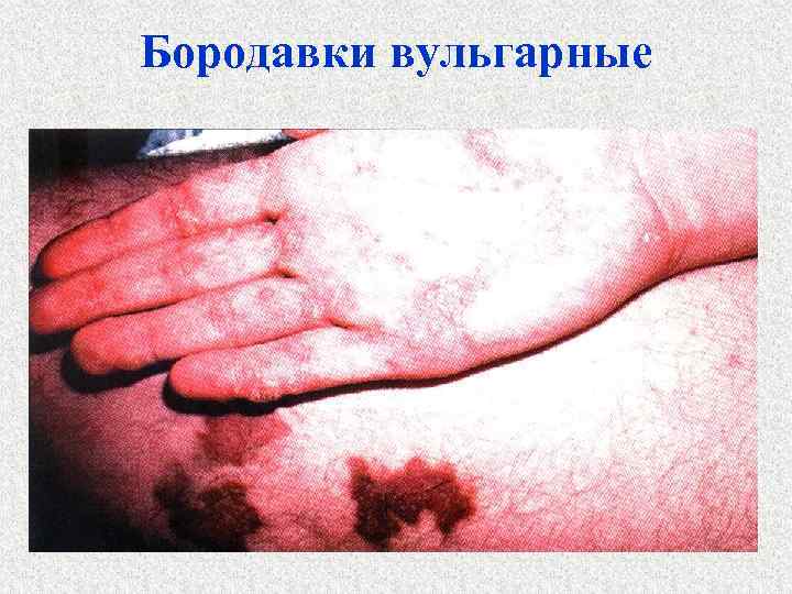 Бородавки вульгарные 