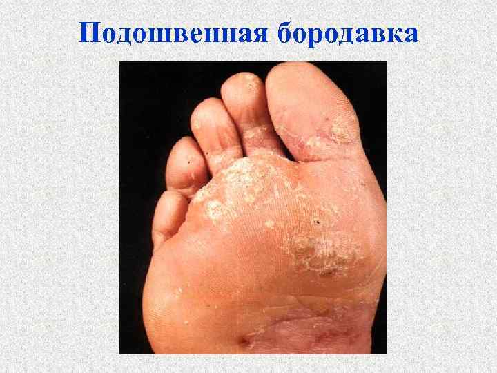 Подошвенная бородавка 