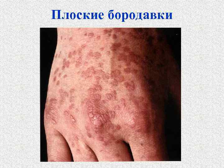 Плоские бородавки 