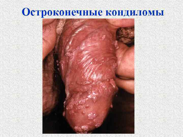 Остроконечные кондиломы 