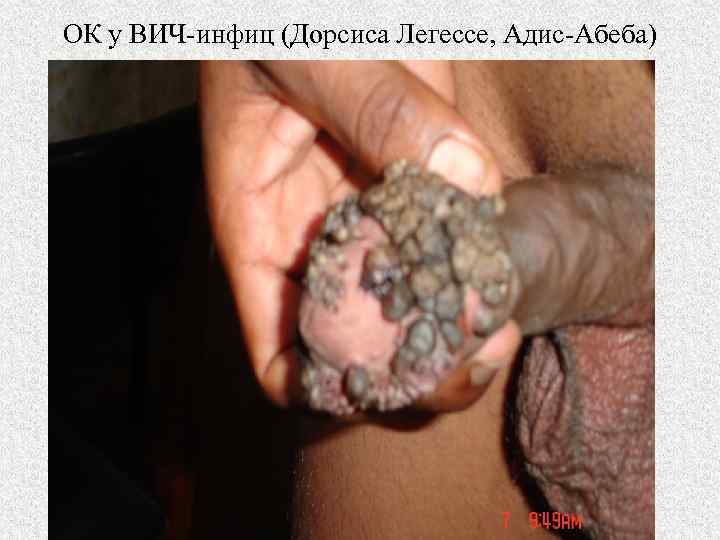 ОК у ВИЧ-инфиц (Дорсиса Легессе, Адис-Абеба) 