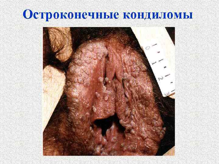 Остроконечные кондиломы 
