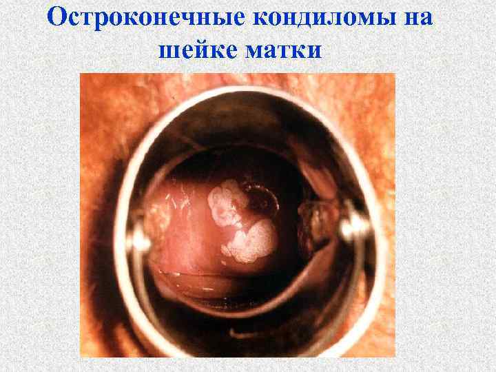 Остроконечные кондиломы на шейке матки 
