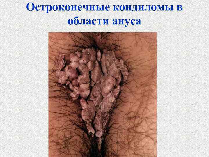 Остроконечные кондиломы в области ануса 