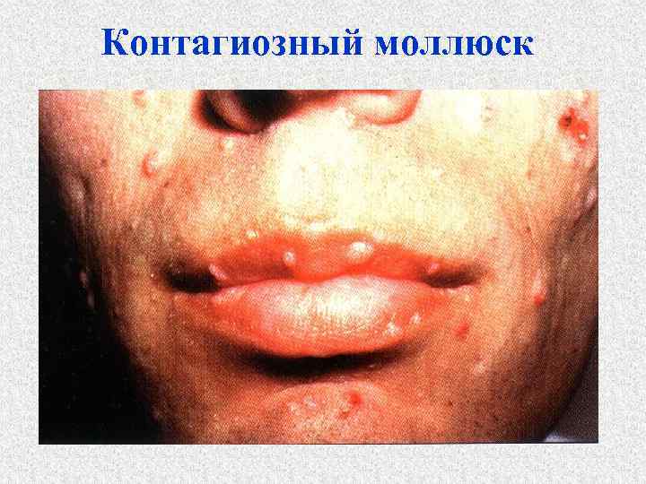 Контагиозный моллюск 