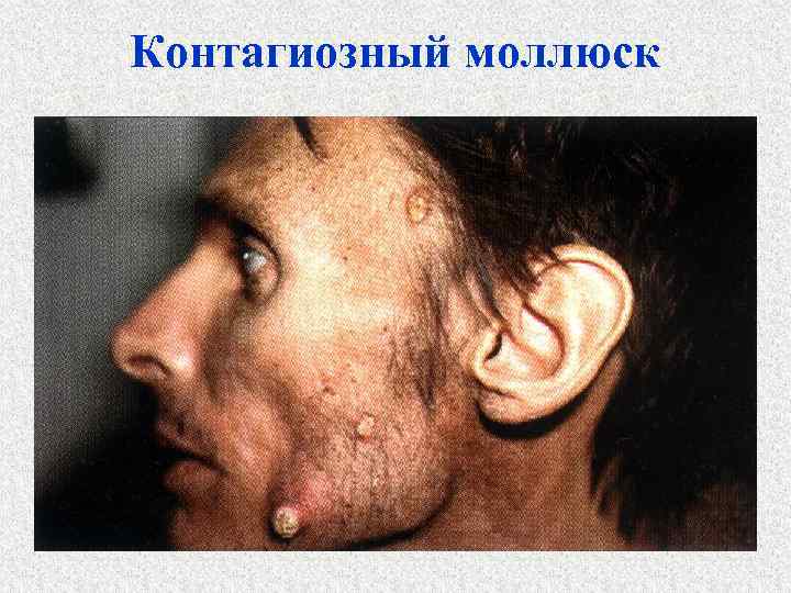 Контагиозный моллюск 