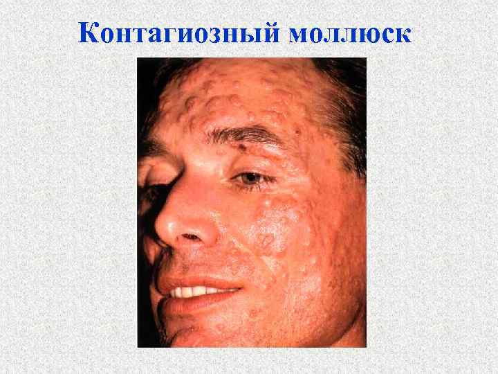 Контагиозный моллюск 