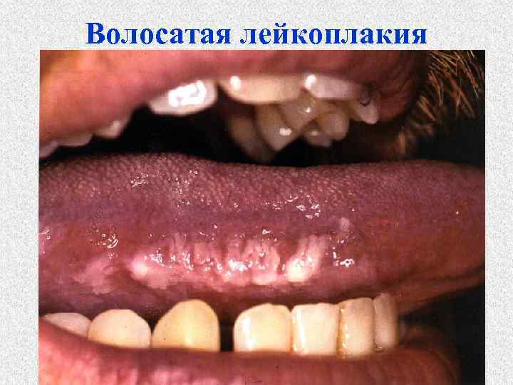 Волосатая лейкоплакия 