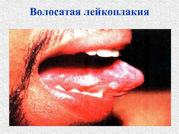 Волосатая лейкоплакия 