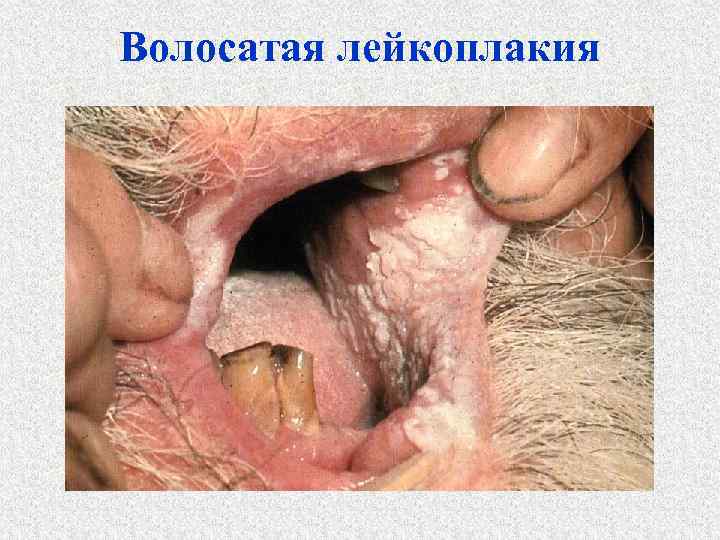 Волосатая лейкоплакия 