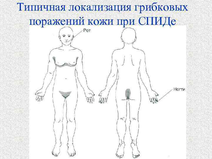 Типичная локализация грибковых поражений кожи при СПИДе 