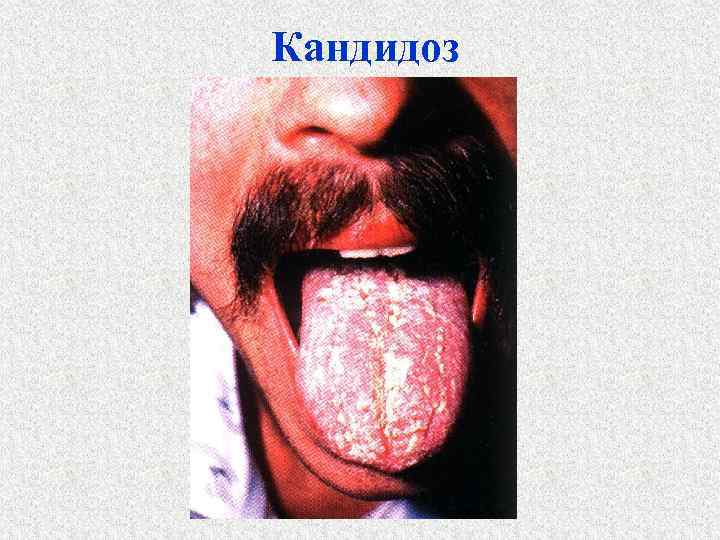 Кандидоз 