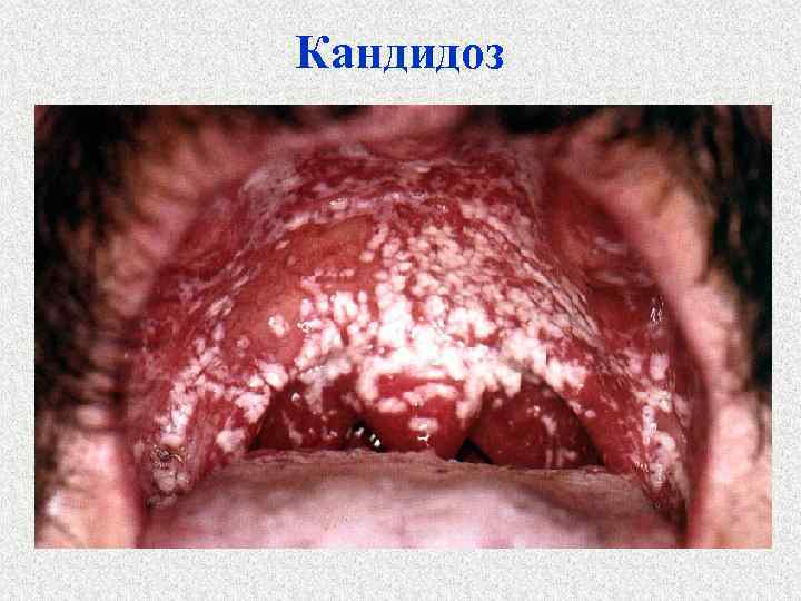 Кандидоз 