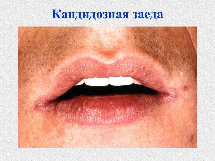 Кандидозная заеда 