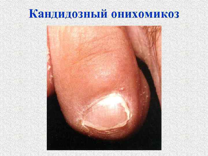 Кандидозный онихомикоз 