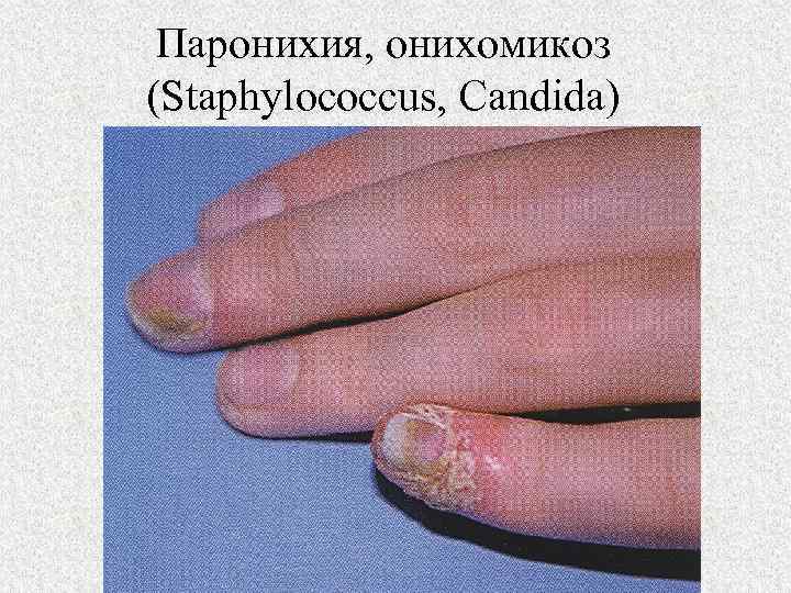 Паронихия, онихомикоз (Staphylococcus, Candida) 