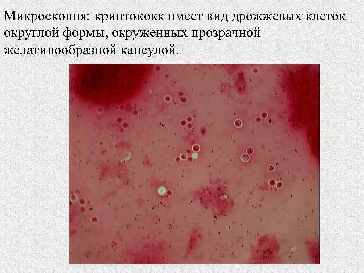 Микроскопия: криптококк имеет вид дрожжевых клеток округлой формы, окруженных прозрачной желатинообразной капсулой. 
