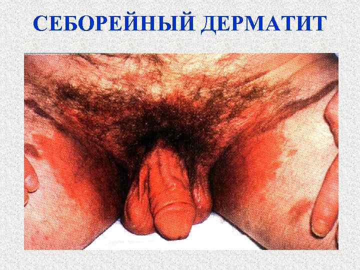 СЕБОРЕЙНЫЙ ДЕРМАТИТ 