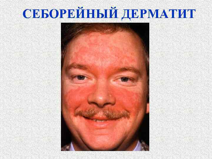 СЕБОРЕЙНЫЙ ДЕРМАТИТ 