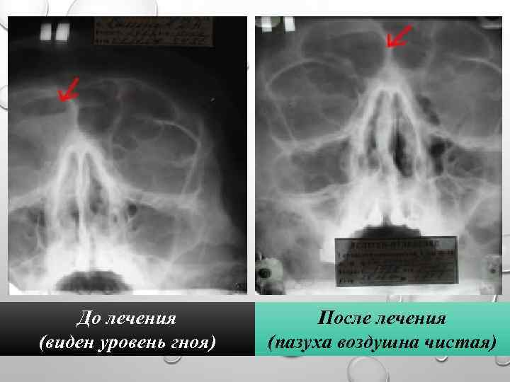 До лечения (виден уровень гноя) После лечения (пазуха воздушна чистая) 