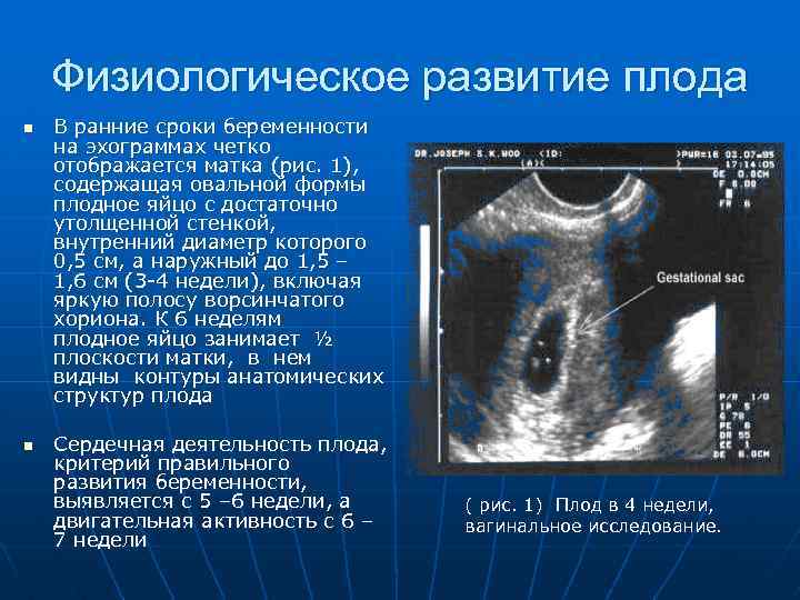  n n Физиологическое развитие плода В ранние сроки беременности на эхограммах четко отображается