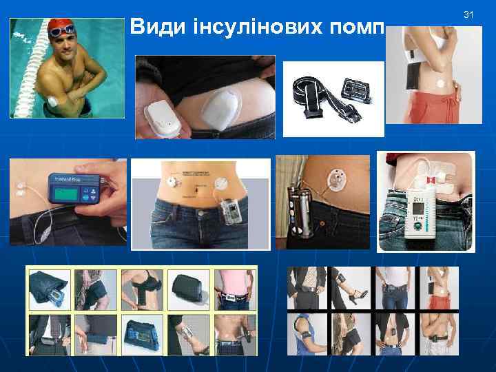 Види інсулінових помп 31 