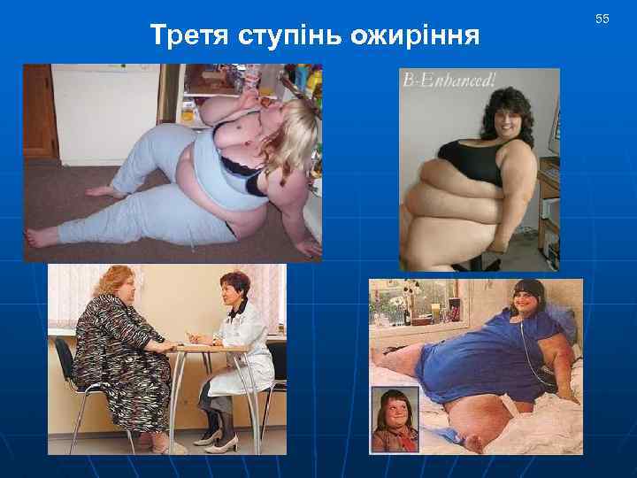 Третя ступінь ожиріння 55 