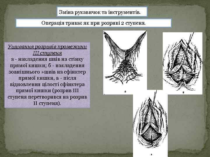 Зміна рукавичок та інструментів. Операція триває як при розриві 2 ступеня. Ушивання розривів промежини