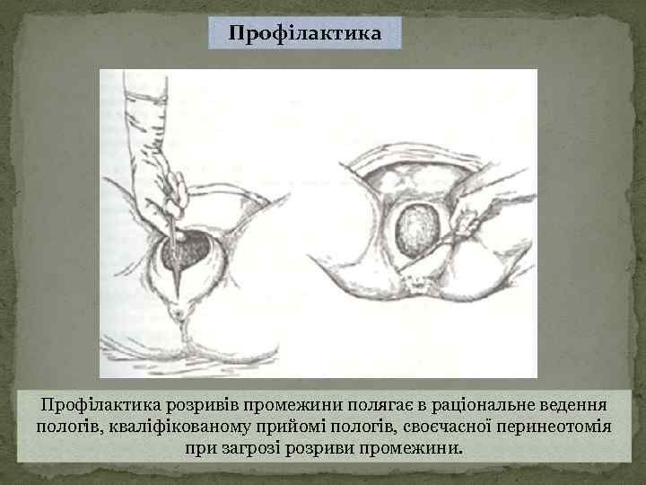 Профілактика розривів промежини полягає в раціональне ведення пологів, кваліфікованому прийомі пологів, своєчасної перинеотомія при