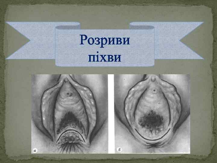 Розриви піхви 