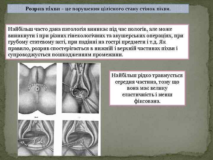 Розрив піхви – це порушення цілісного стану стінок піхви. Найбільш часто дана патологія виникає