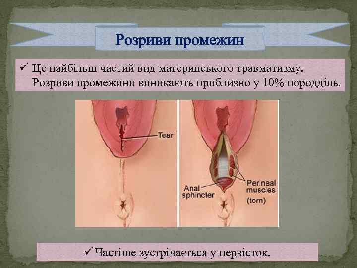 Розриви промежин ü Це найбільш частий вид материнського травматизму. Розриви промежини виникають приблизно у